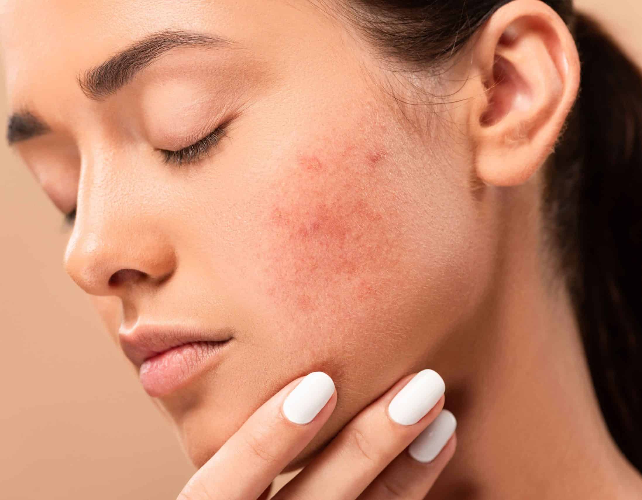 Acne spots | M Spa Mystic