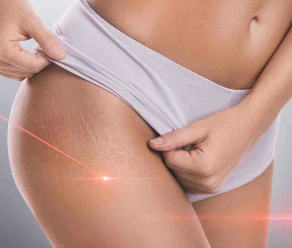 Stretch Marks | M spa Mystic