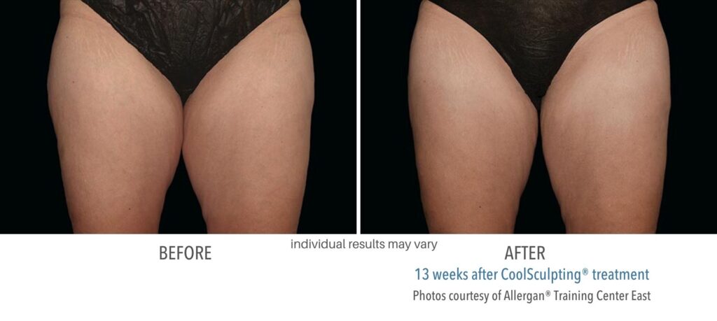 CoolSculpting before and after | M spa at Mystic