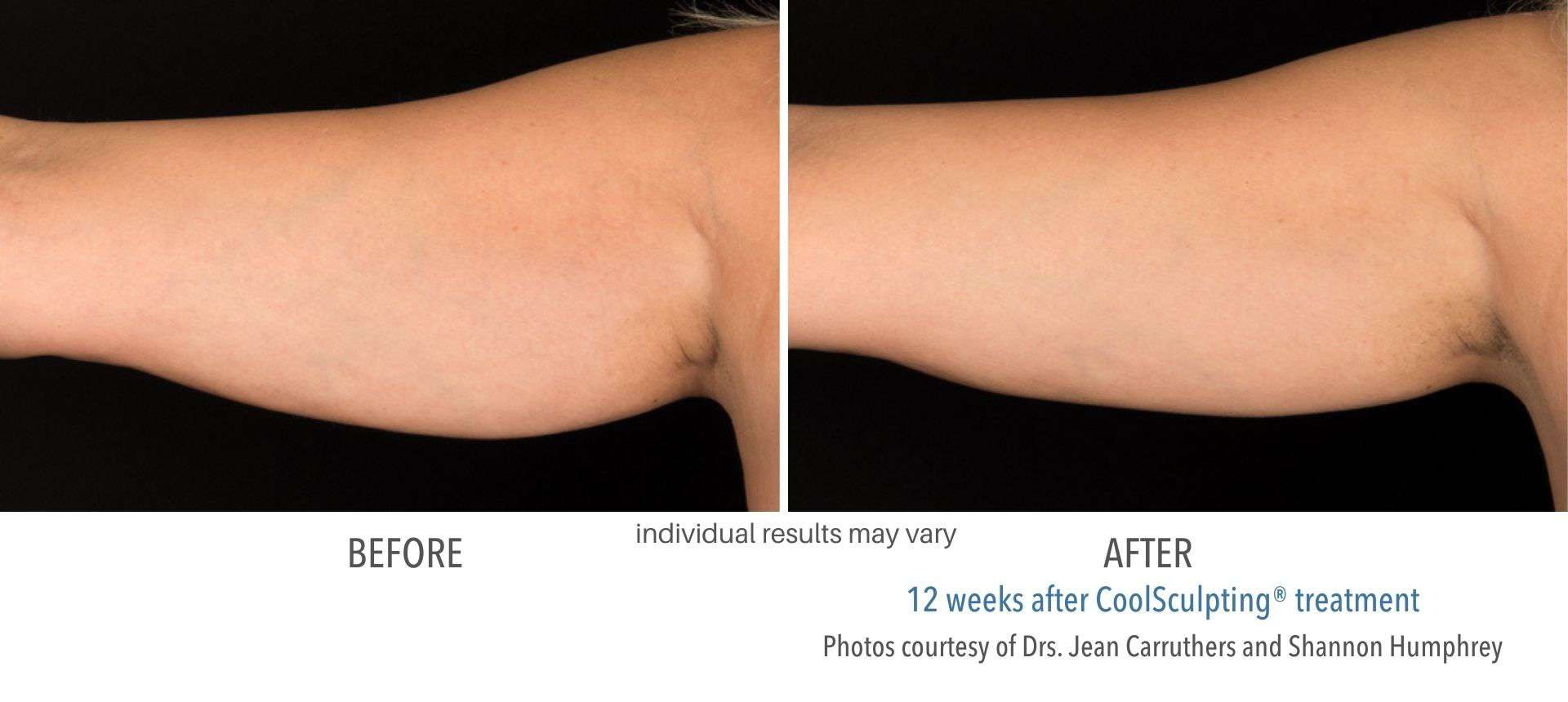 CoolSculpting before and after | M spa at Mystic