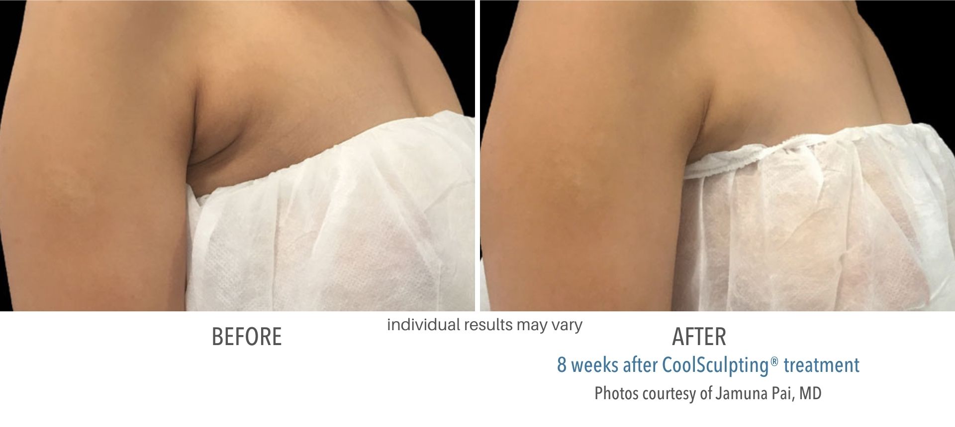 CoolSculpting before and after | M spa at Mystic