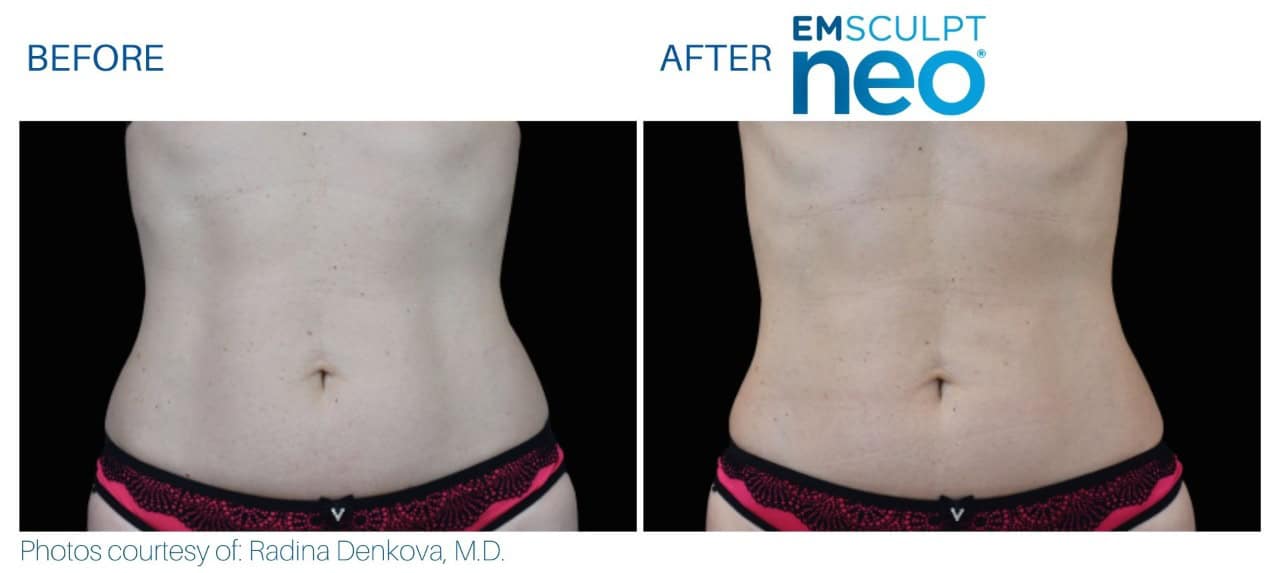 Emsculpt Before and after | M spa at Mystic