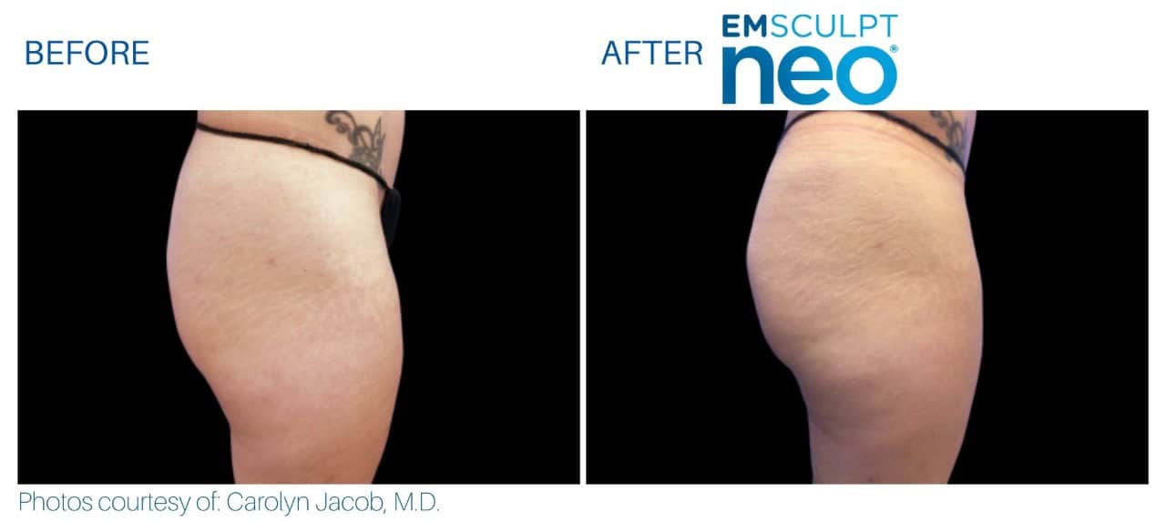 Emsculpt Before and after | M spa at Mystic