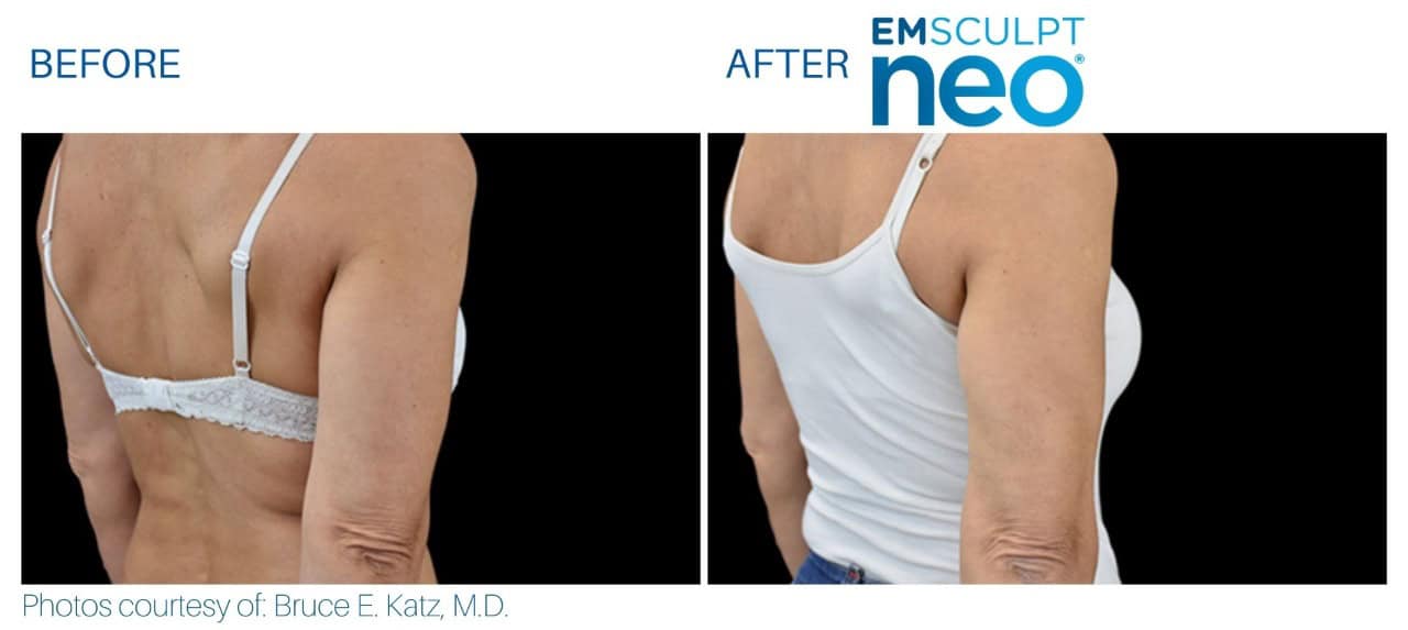 Emsculpt Before and after | M spa at Mystic