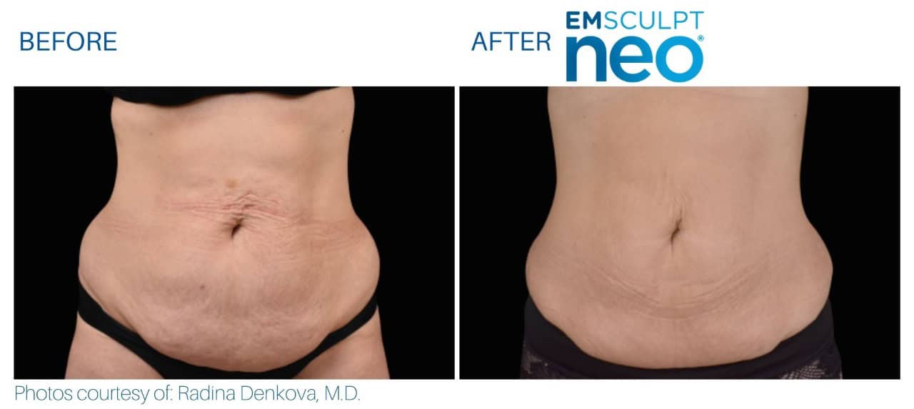 Emsculpt Before and after | M spa at Mystic