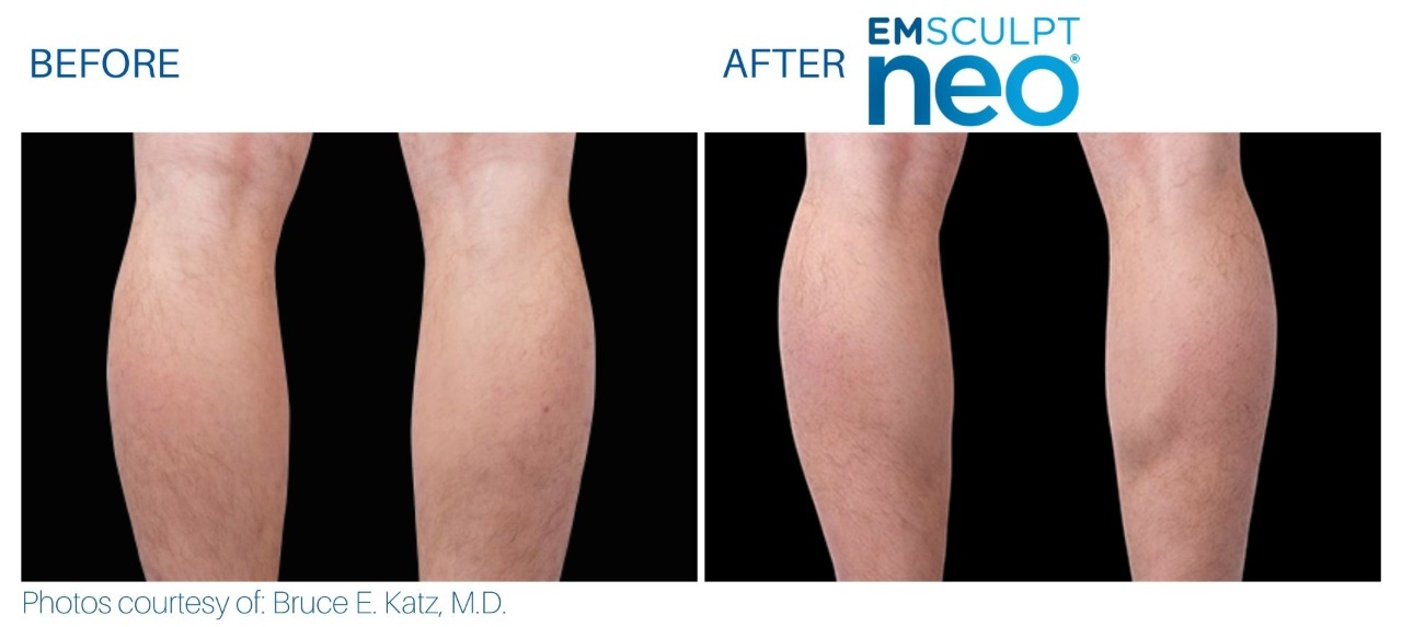 Emsculpt Before and after | M spa at Mystic
