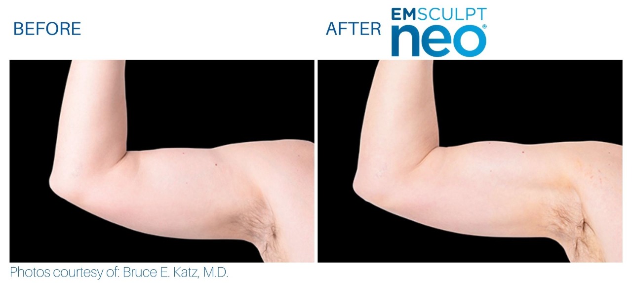 Emsculpt Before and after | M spa at Mystic