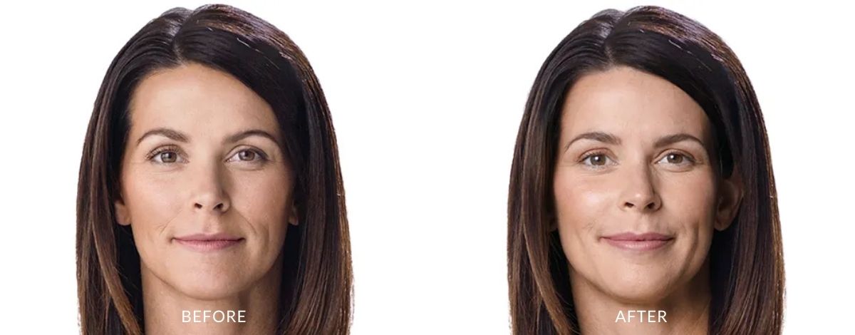 Juvederm Before and after | M spa at Mystic