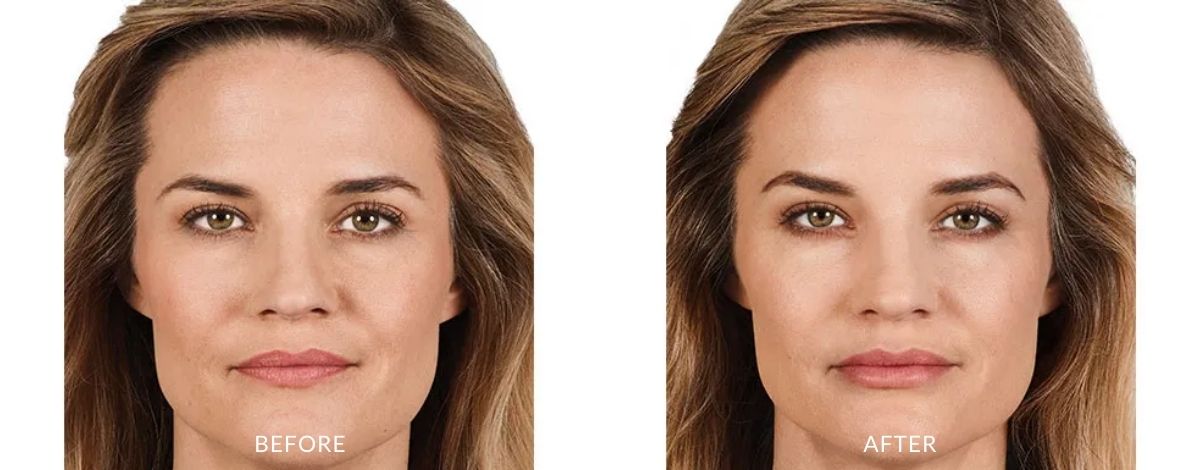 Juvederm Before and after | M spa at Mystic