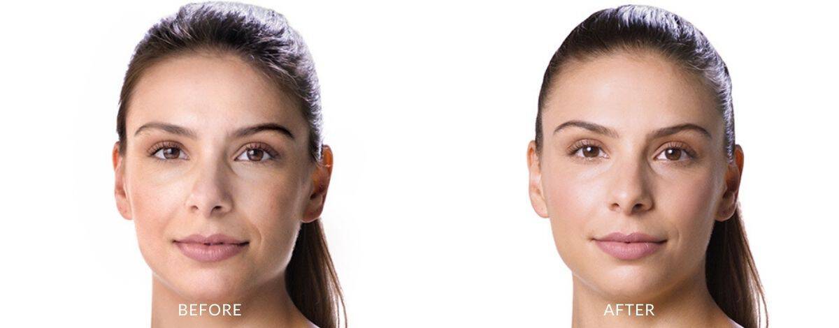 Juvederm Before and after | M spa at Mystic