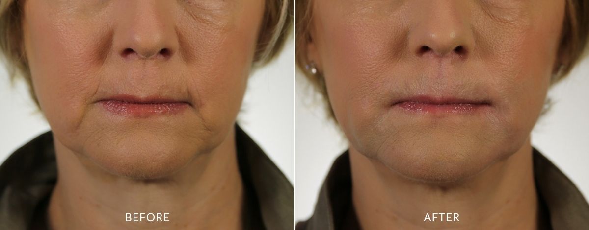 Versa Before and after | M spa at Mystic