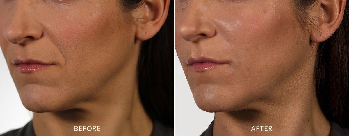 Versa Before and after | M spa at Mystic