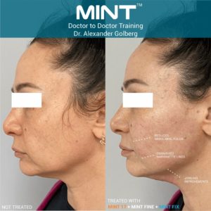 Mint pdo before and after | Mspa