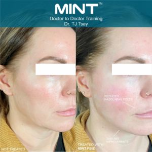 Mint pdo before and after | Mspa