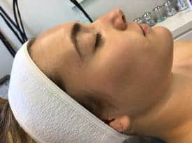 Microneedling before & after dk4