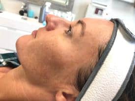 Microneedling before & after | Mspa mystic