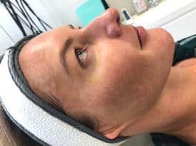 Microneedling before & after | Mspa mystic