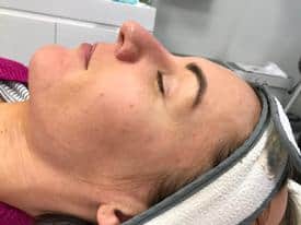 Microneedling before & after | Mspa mystic