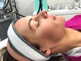 Microneedling before & after | Mspa mystic