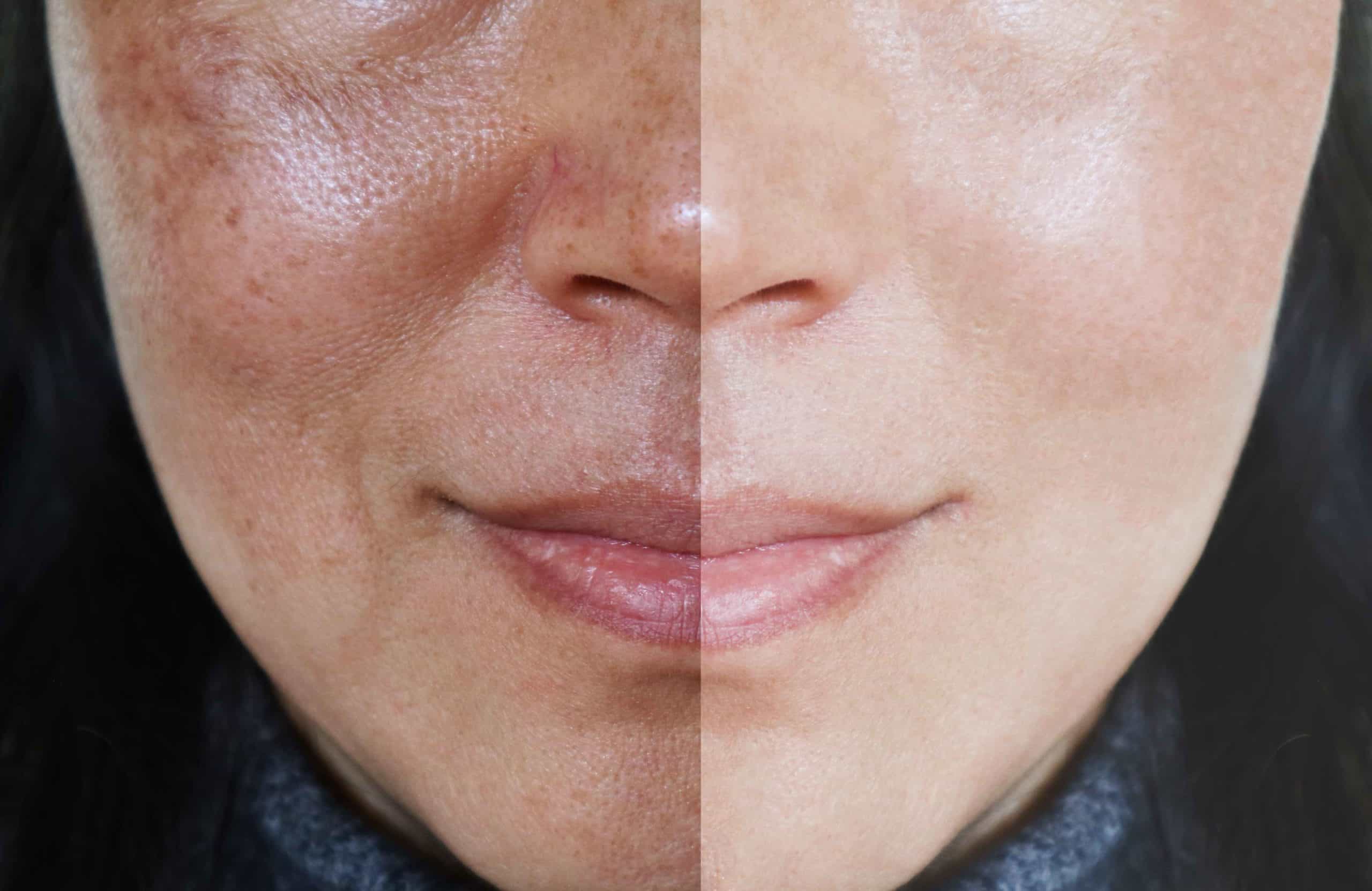 Moisturize Before and after | M spa at mystic