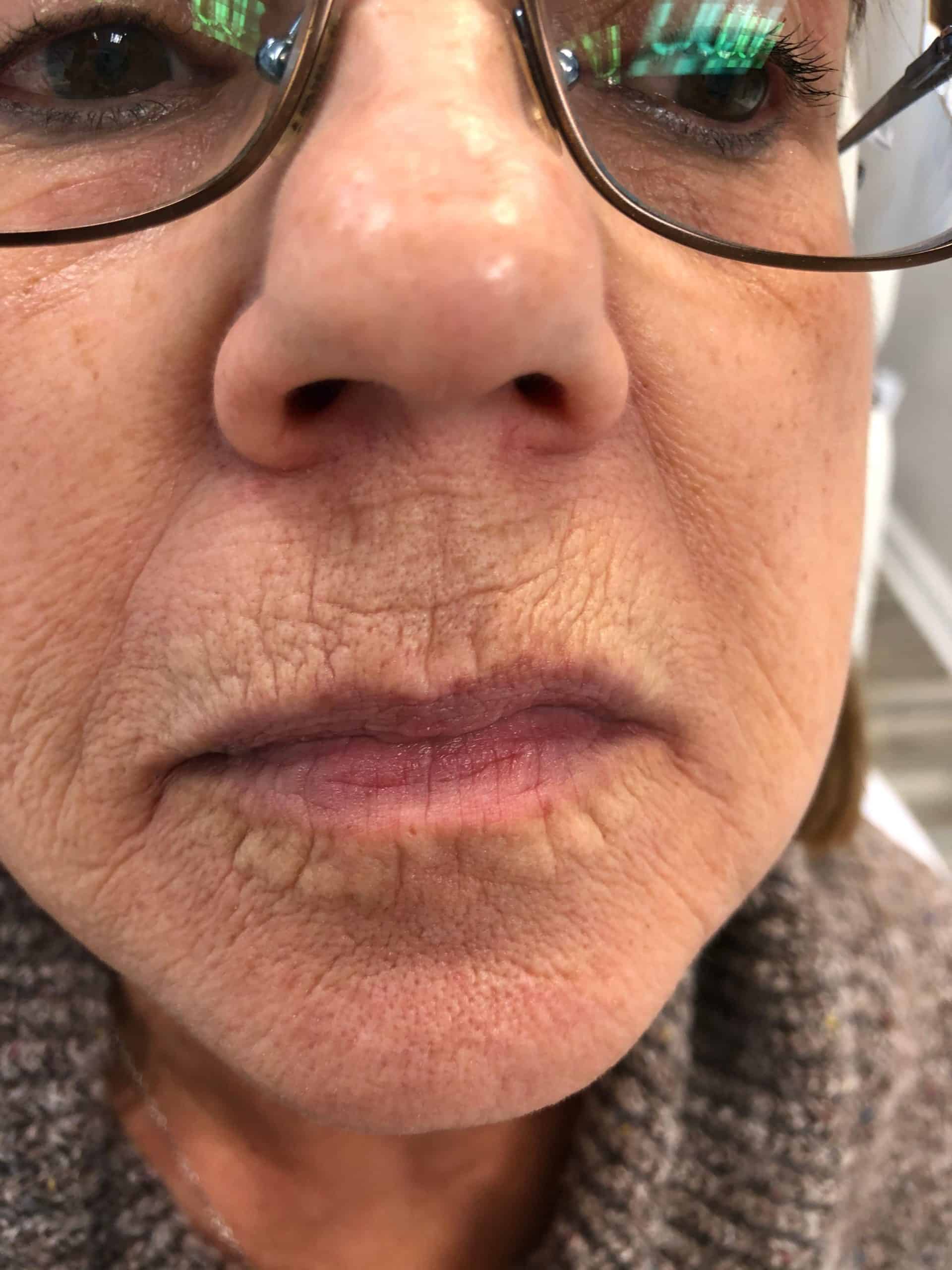 RF Microneedling before & after df1