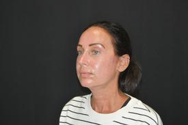 RF Microneedling before & after jg6