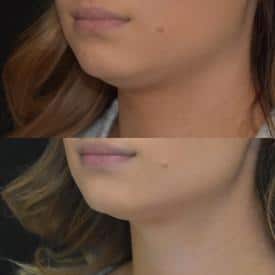 kybella before&after | M Spa Mystic