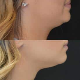 kybella before&after | M Spa Mystic