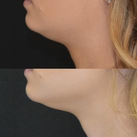 kybella before&after | M Spa Mystic